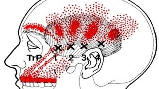 trigger point face